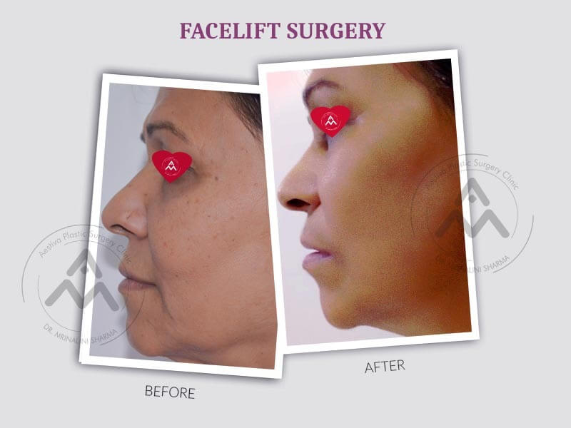 Facelift Surgery